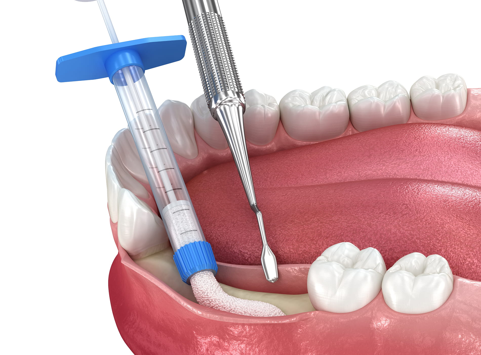 Explore different types of bone grafting procedures designed to rebuild and strengthen your jawbone.