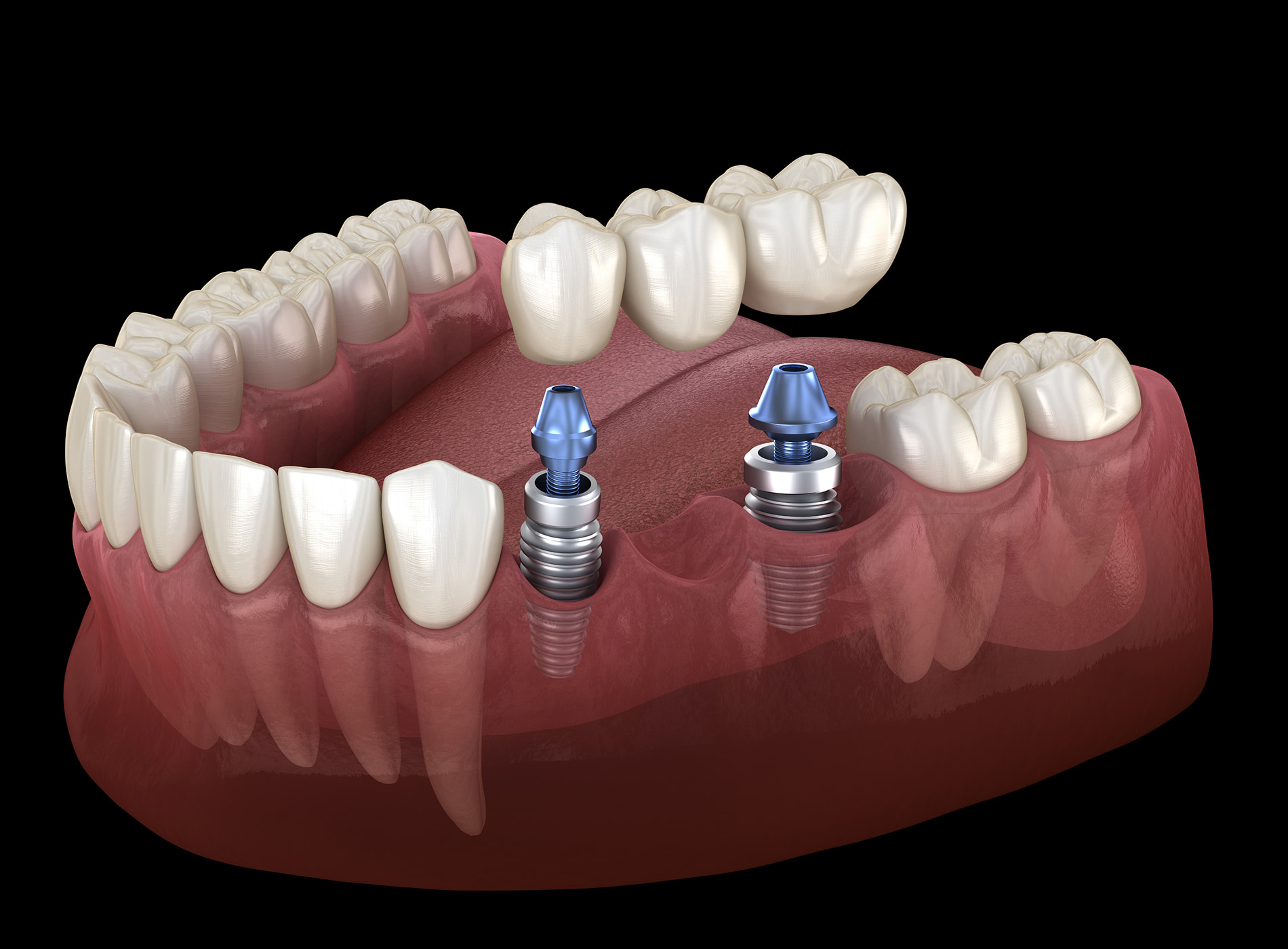 Implant-supported bridges at Dullat Cosmetic Dental & Implants in San Jose